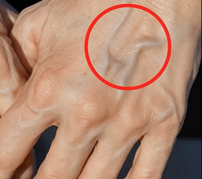 What Causes Sudden Bulging Veins—and When to Worry