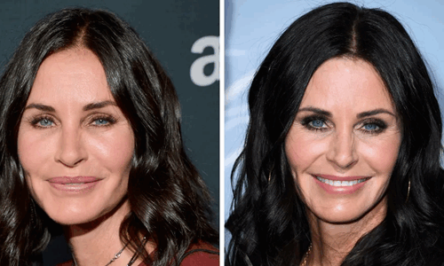 11 Celebrities Who Chose to Remove Their Fillers – Before and After Pictures