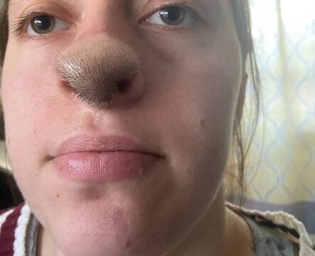 From Bite to Bizarre: Woman Grows Nose Hair Following Dog Attack!