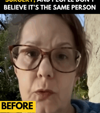 $15K Facelift Reveal Sparks Online Frenzy After Woman Shares Transformation