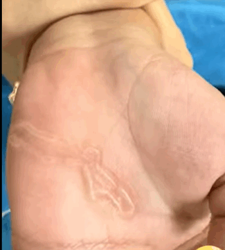 Florida Teen Contracts Painful Hookworm Infection After Being Buried in Sand