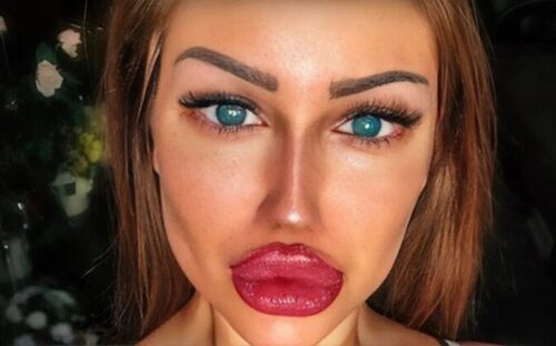 A Doll-Like Disaster! The girl’s cosmetic surgery gone wrong sparks outrage