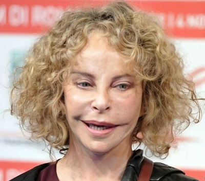 Once famous for her distinctive looks, she now appears completely different after multiple cosmetic procedures.