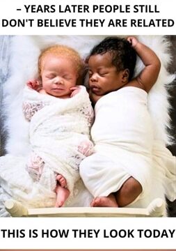 “Doctors Stunned as Mother Delivers Twin Boys with Different Skin Colors!”