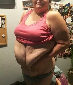 After Dropping Half Her Bodyweight, Bride-to-Be Gets 17lb of Saggy Skin Removed