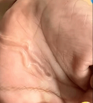 Teen in Florida Suffers Painful Parasitic Infection Linked to Contaminated Sand