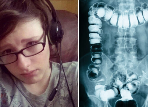 Teen Sent Home With “Constipation” Dies 24 Hours Later — A Tragic Story That Shows Why Early Diagnosis Matters