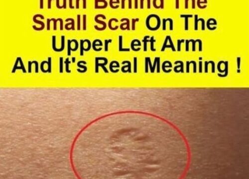 What Do Smallpox Vaccine Scars Look Like and Why Do They Form?