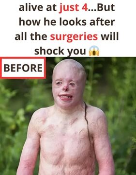 The Boy Who Endured the Fire: Rebuilding Life After 95% Burns — His Journey Redefines True Strength