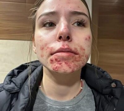 Why Pimples Keep Appearing on Your Chin: The Hidden Causes