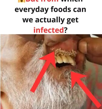 Mouth Infestation: The Shocking Truth About Oral Myiasis Most People Haven’t Heard Of