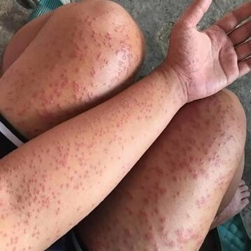 I spent a couple of nights at my friend’s previous apartment and saw these unusual bumps…