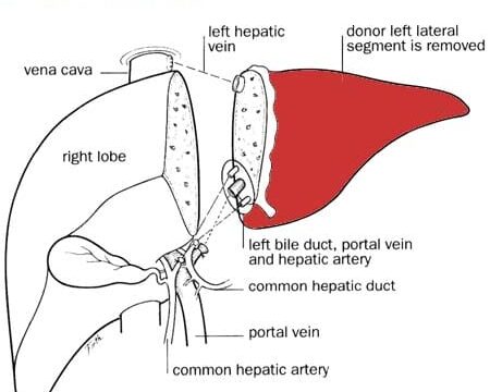 What You Need to Know About Living Liver Donation: Risks and Rewards