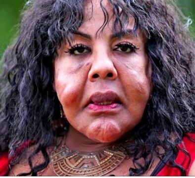 “She Was Injected With Cement — See Her Shocking Transformation 14 Years Later!”